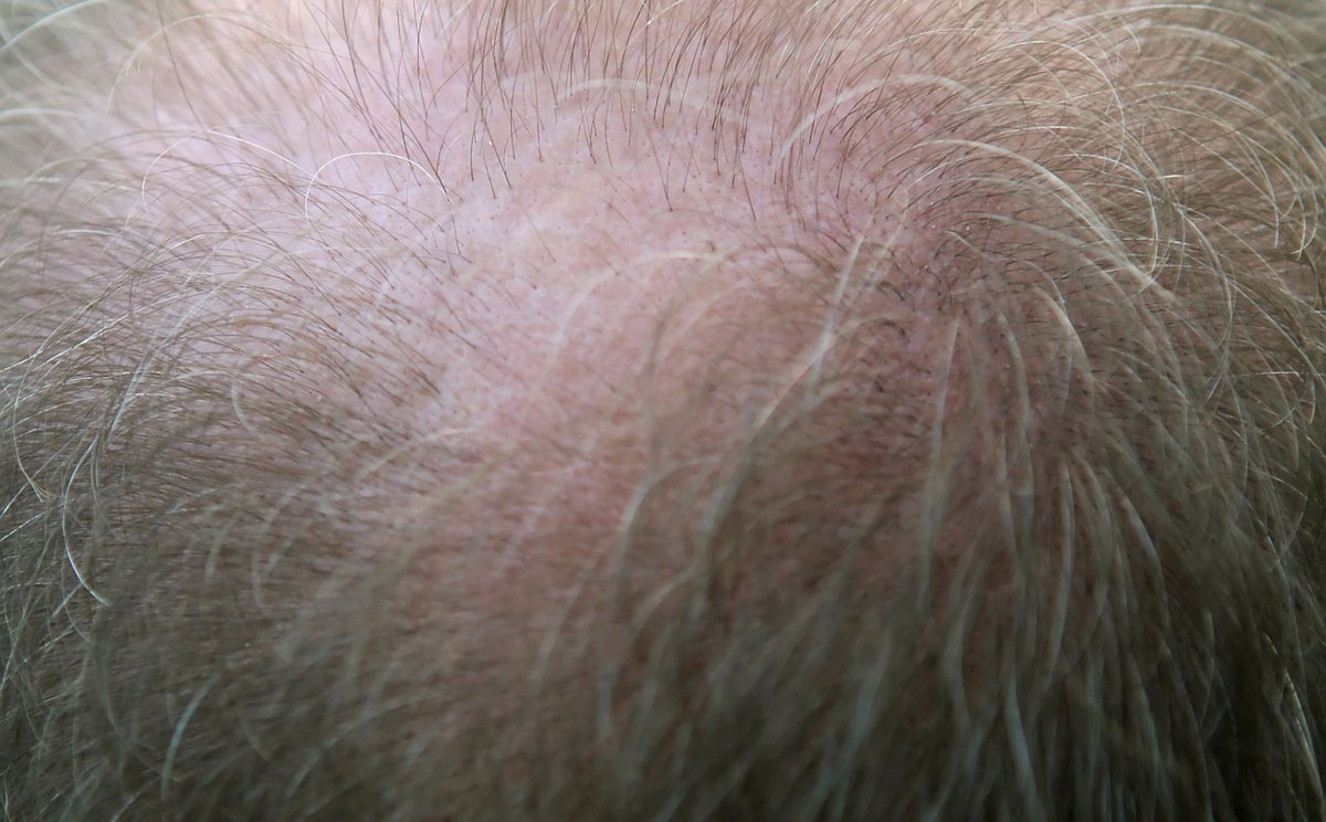 Growing Skeptical of Hair Restoration