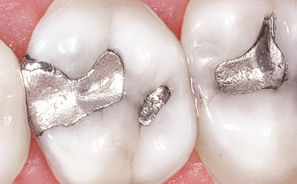 Mercury Fillings