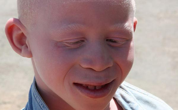 Albinism Facts and Fiction