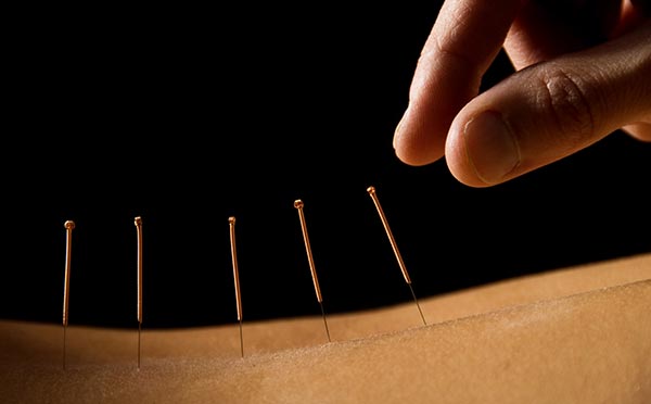 Acupuncture